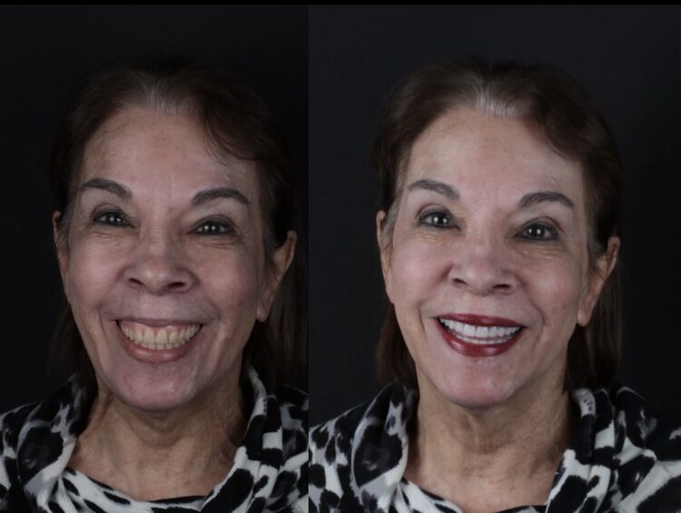 Ela chegou até nós insatisfeita com o sorriso. Tinha feito uma prótese protocolo em outra clínica, mas o resultado não refletia quem ela realmente era. A estética não agradava: muita gengiva à mostra, coloração artificial, dentes desproporcionais ao formato do rosto. Tudo isso tirava a naturalidade — e a autoestima. Foi aí que entrou a irmã dela, Dona Jandira — nossa paciente querida, que já tinha passado por um tratamento conosco e ficou encantada com o resultado. Por confiança e carinho, ela nos indicou. E a partir desse encontro, tudo começou a mudar. Analisamos o caso com muito critério e decidimos seguir o caminho mais inteligente: mantivemos os implantes já existentes (sem a necessidade de novos procedimentos cirúrgicos!) e substituímos toda a prótese — focando em proporção, harmonia facial e naturalidade. O resultado? Um novo sorriso. Uma nova expressão. Uma nova fase. Ela saiu feliz, confiante e completamente transformada. Esse é o tipo de reabilitação que amamos fazer: técnica, precisa e feita com o coração. Esse é o Padrão Escudero de cuidar de você. 🙌🏼